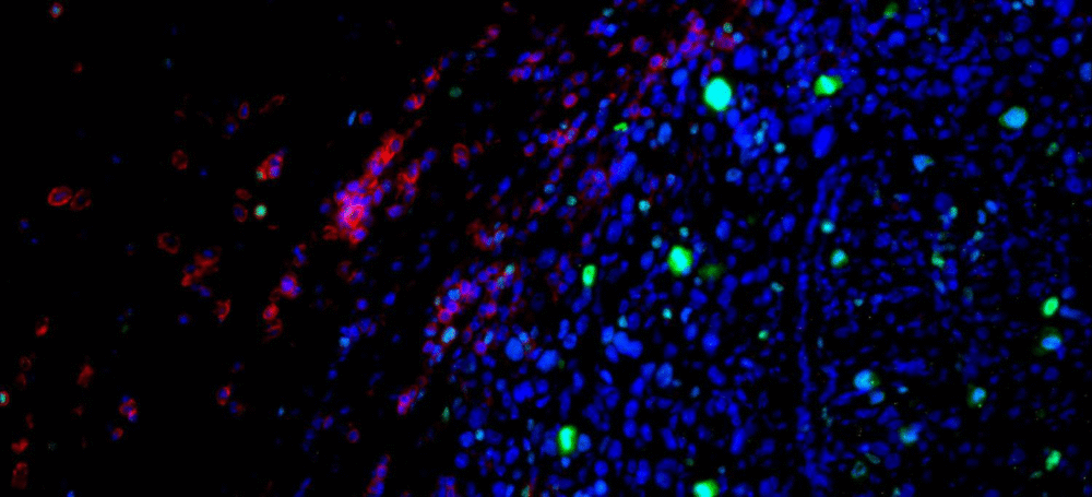 How Restricted Blood Flow May Actually Supercharge Cancer Growth How Restricted Blood Flow May Actually Supercharge Cancer Growth