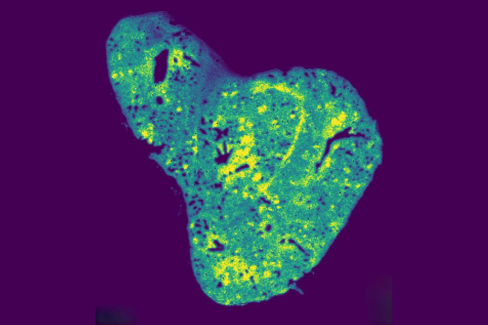 How a Tiny Molecule Inside Our Cells Might Explain Why Cancer Spreads How a Tiny Molecule Inside Our Cells Might Explain Why Cancer Spreads