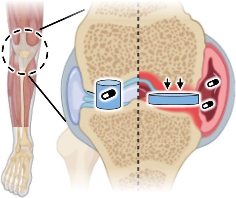 Artificial Cartilage That Delivers Drugs on Demand Could Transform Arthritis Treatment
