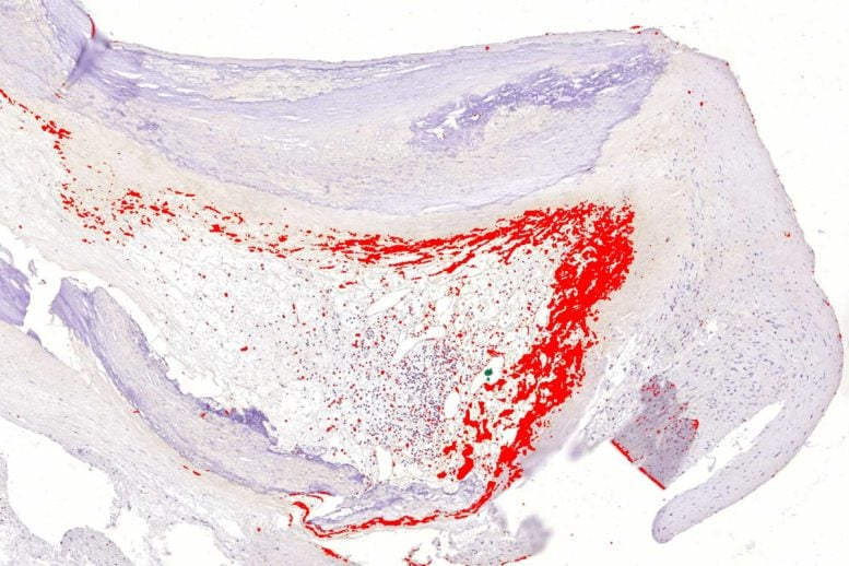 Heart Attacks May Be Linked to Hidden Infections: New Research Opens Surprising Possibilities