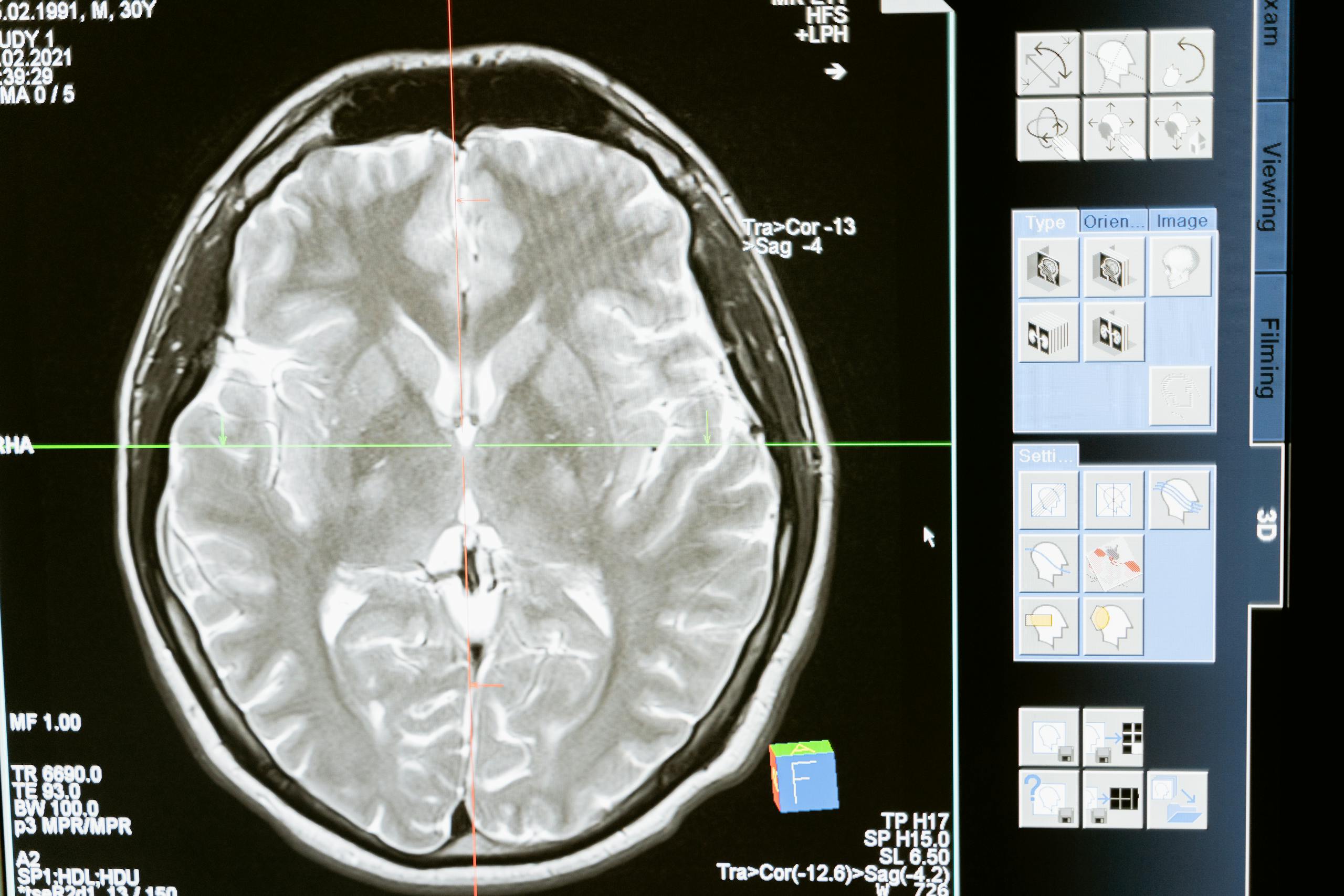 Stanford Scientists Reveal How the Brain Builds and Refines Motor Memories Intricate MRI brain scan displayed on a computer screen for medical analysis and diagnosis.