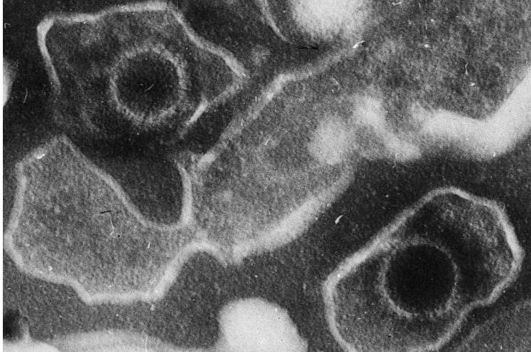 Scientists Identify Epstein–Barr Virus as a Direct Driver of Lupus
