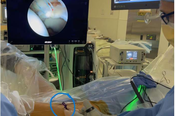 New CAP-LIFT Cannula Redefines Hip Arthroscopy With a More Precise and Safer Surgical Approach