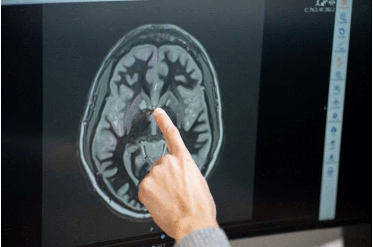 Tirzepatide May Quiet Food Noise in the Brain but Only for a Limited Time