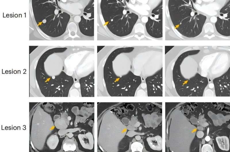 Experimental Liver Cancer Vaccine Shows Strong Early Results for Young Patients