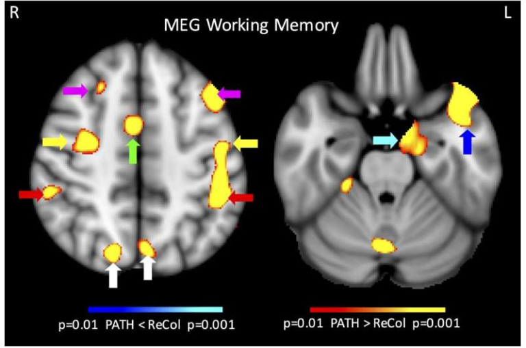 Visual Training After Concussion Shows Remarkable Gains in Memory, Attention, and Cognitive Function