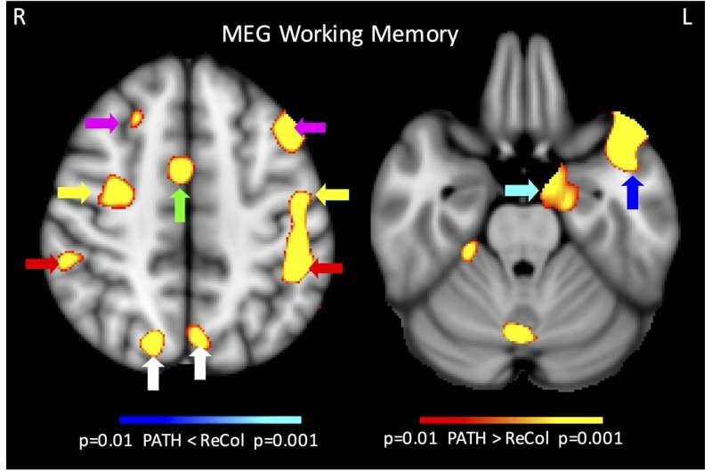 Visual Training After Concussion Shows Remarkable Gains in Memory, Attention, and Cognitive Function
