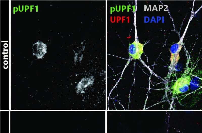 Scientists Discover RNA Quality Control Failure Linked to ALS Progression