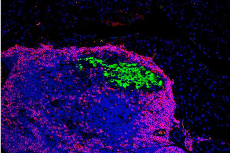 Disabling a Single Stress Gene Helps Protect Pancreatic Cells From Type 1 Diabetes in Mice