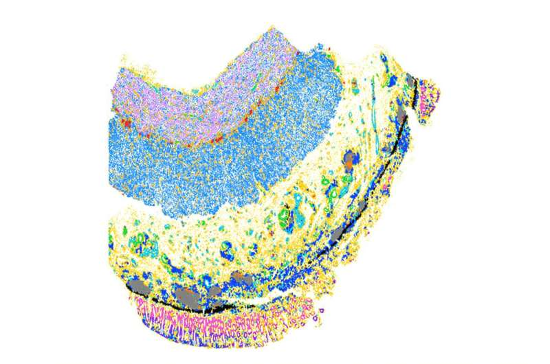 Researchers Uncover Molecular Roots of Tissue Scarring in Inflammatory Bowel Disease