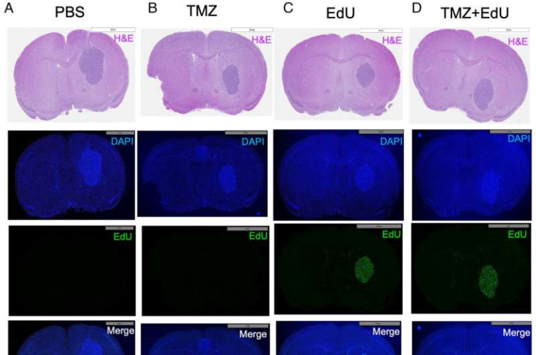 Combination Therapy Against Brain Cancer Shows Remarkable Success in Preclinical Glioblastoma Models