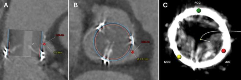 First Minimally Invasive Coronary Artery Bypass Achieved for High-Risk Heart Patients