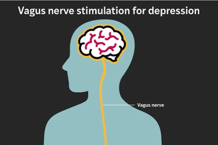 Implant Provides Lasting Relief for Treatment-Resistant Depression, Study Finds